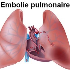 Embolie Pulmonaire et Covid-19 (Dr Colas Tchérakian)
